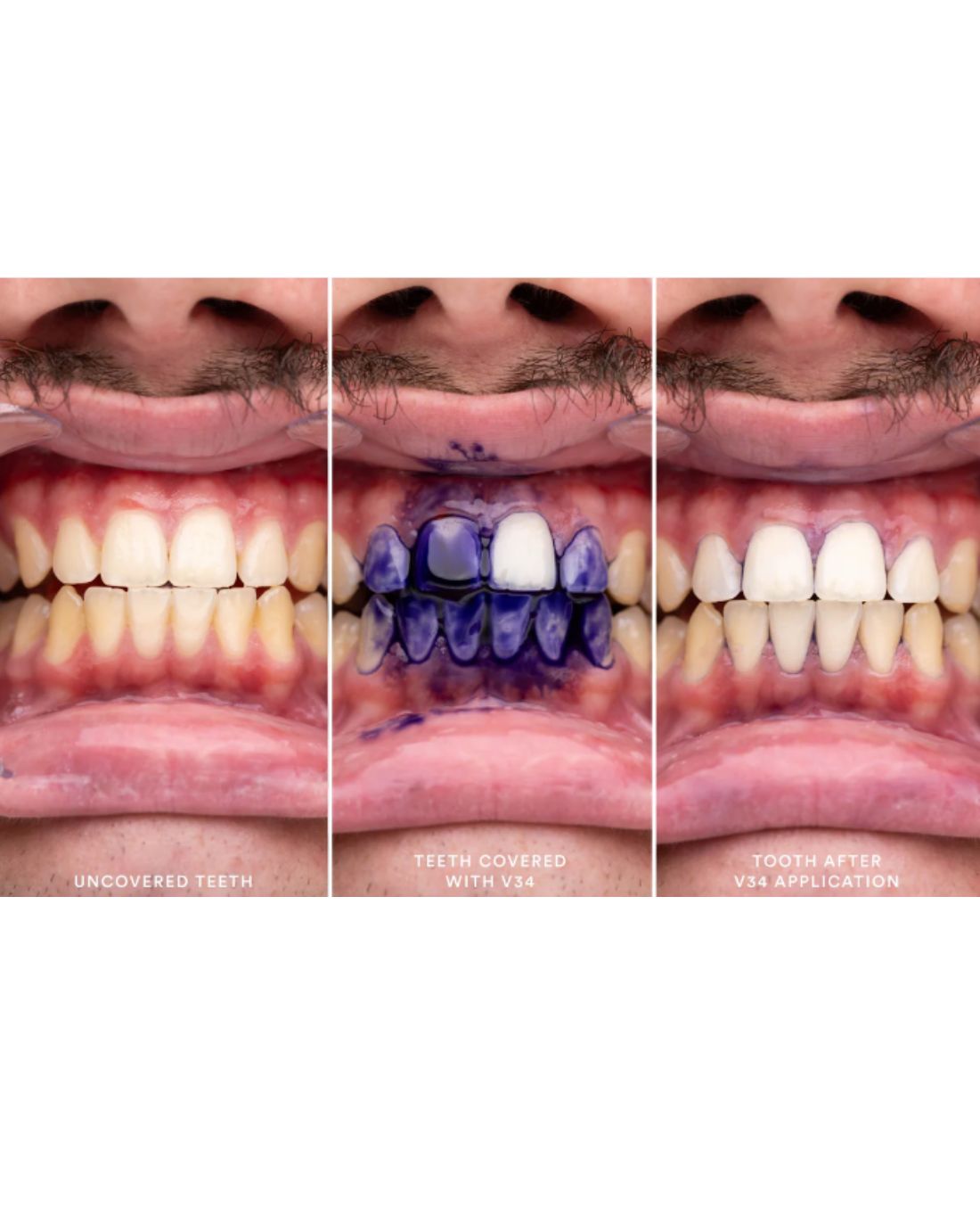 HiSmile V34 Crema Blanqueadora