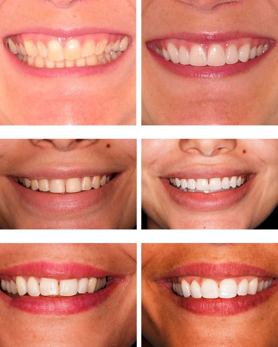 HiSmile V34 Crema Blanqueadora
