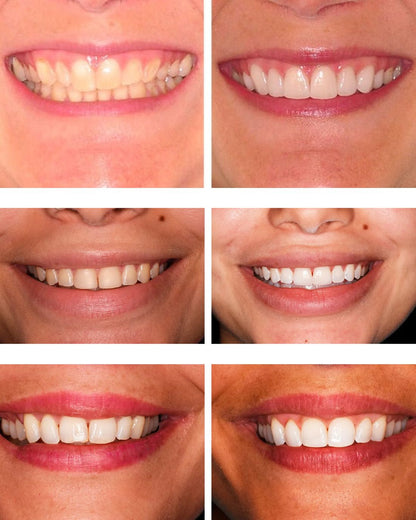 HiSmile V34 Crema Blanqueadora