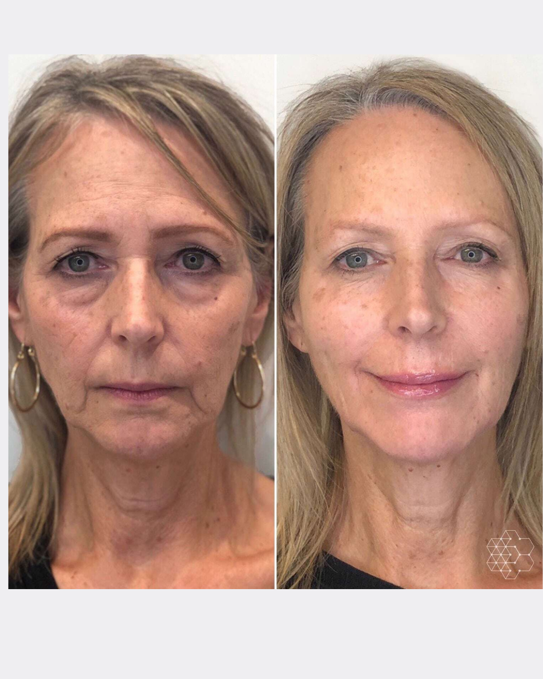 Celimax Retinal - Antiedad efecto en días